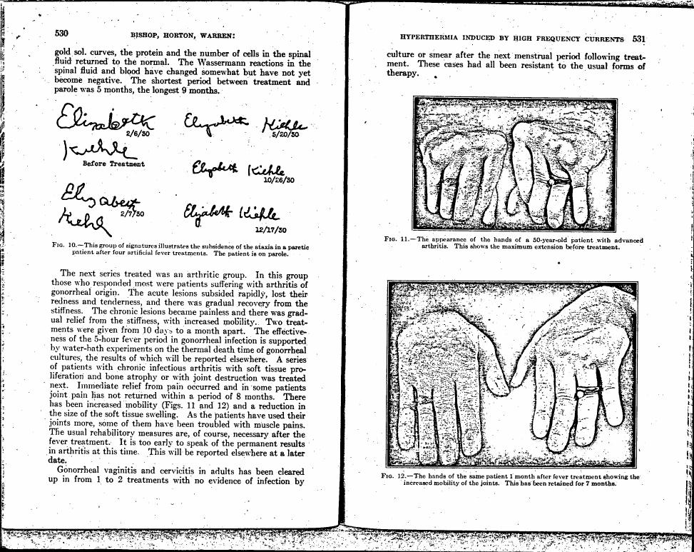 AI-described figure: Fig. 12 shows the hands of a patient one month after fever treatment, highlighting increased joint mobility.