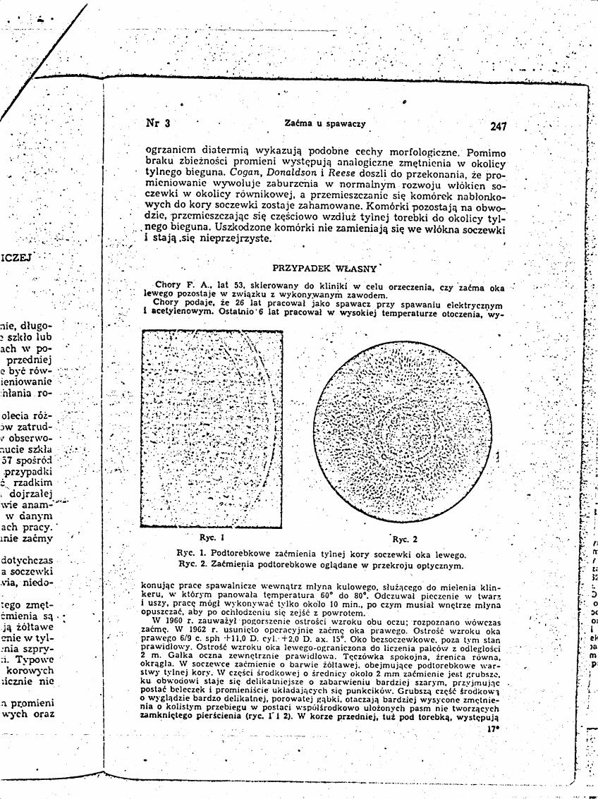 AI-described figure: Figure 1 and Figure 2 show microscopic images of ocular lens changes in a case study.