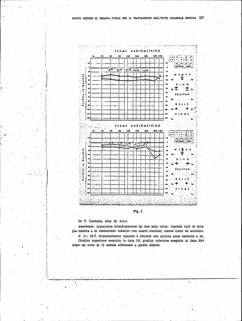 AI-described figure: Figure 5: Audiometric examination results for a patient aged 55 with chronic otitis media.