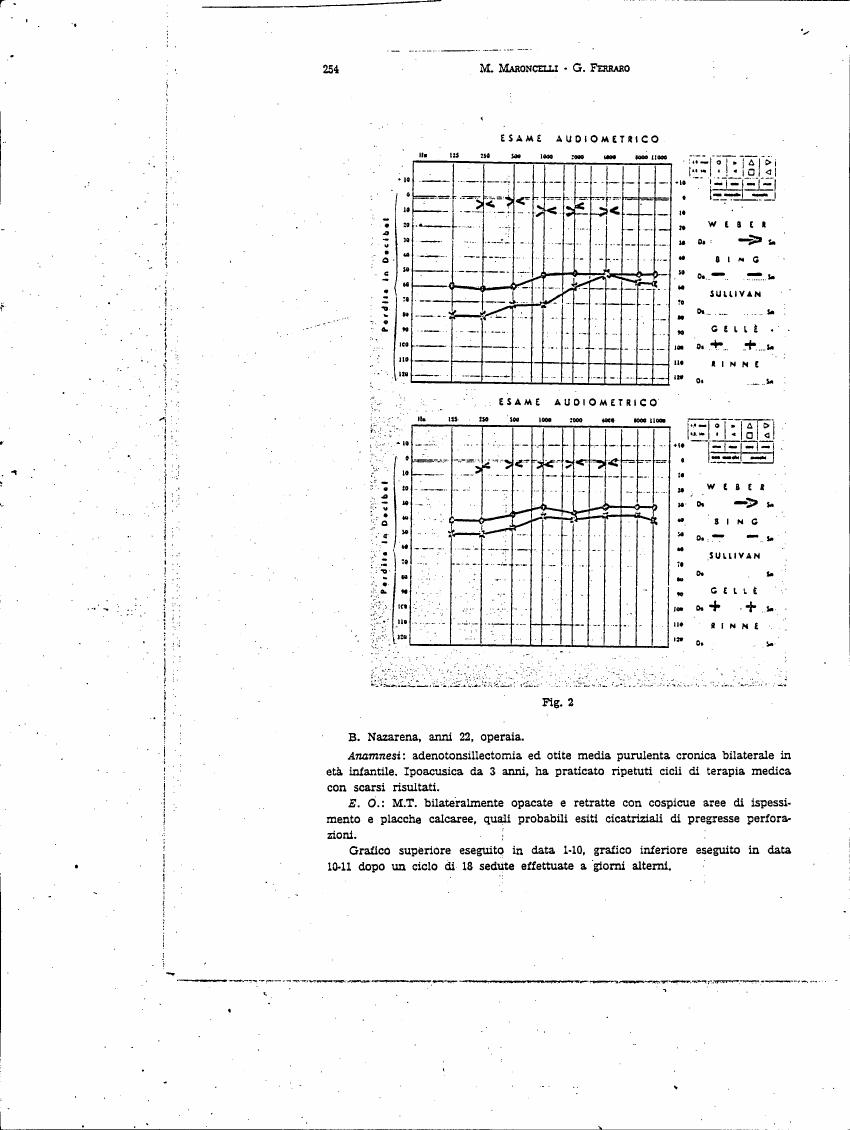 AI-described figure: Audiometric test results for B. Nazarena, a 22-year-old woman with chronic bilateral otitis media purulenta and previous medical therapy.