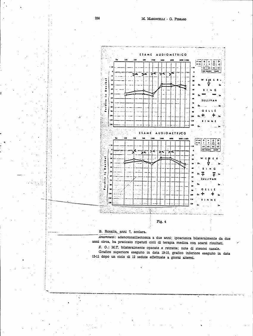AI-described figure: Figure 4: Audiometric test results for B. Rosalia, a 7-year-old student with adenotonsillectomy history and bilateral opacification of the middle ear.