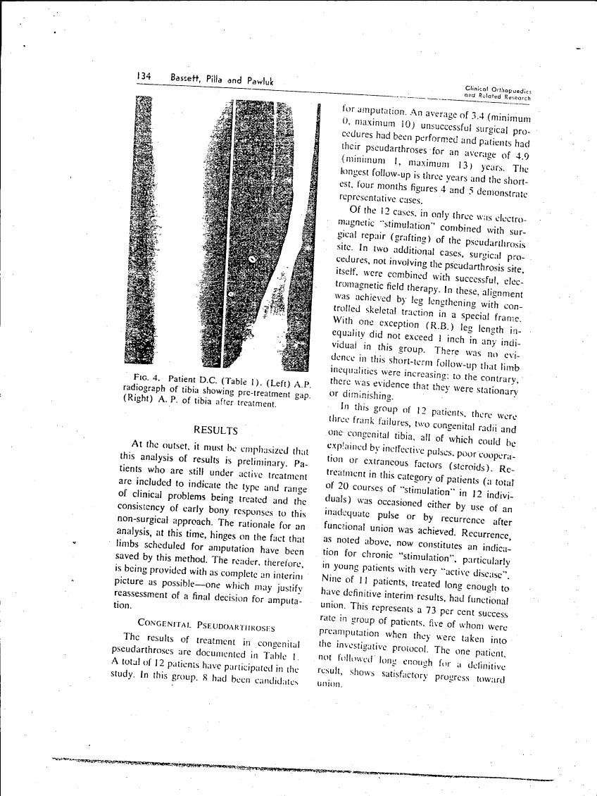 AI-described figure: Figure 4 displays a radiograph comparing pre-treatment and post-treatment gaps in tibia for patient D.C.