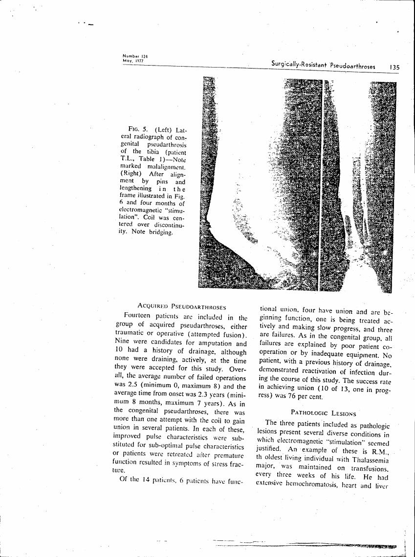 Fig. 5 displays a lateral radiograph comparing congenital pseudoarthrosis before and after treatment.