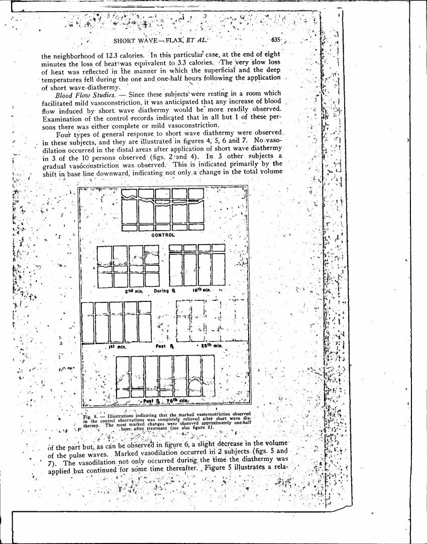 AI-described figure: Illustrations indicating that marked vasoconstriction observed in control observations was completely relieved after short wave diathermy. The most marked changes were observed approximately one-half hour after treatment.