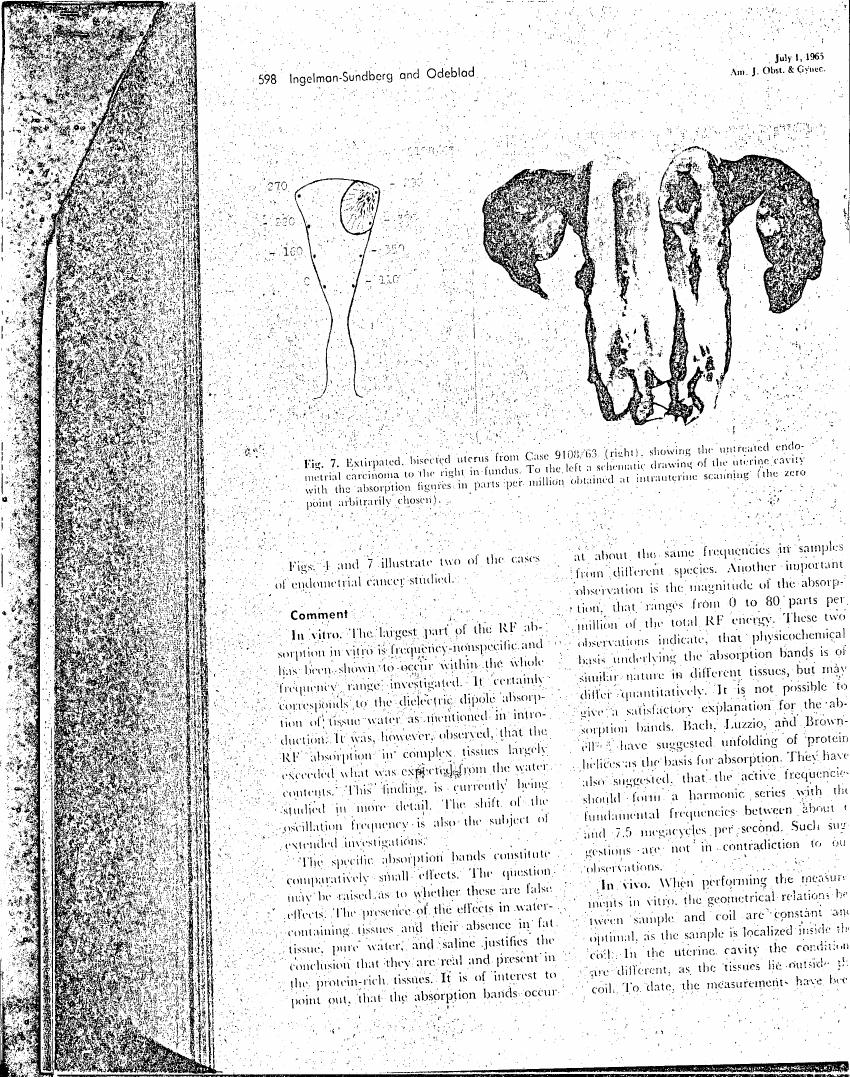 AI-described figure: Fig. 7: Exirpated, bisected uterus from Case 9106-63 (right), showing the untreated endometrial carcinoma to the right in fundus.