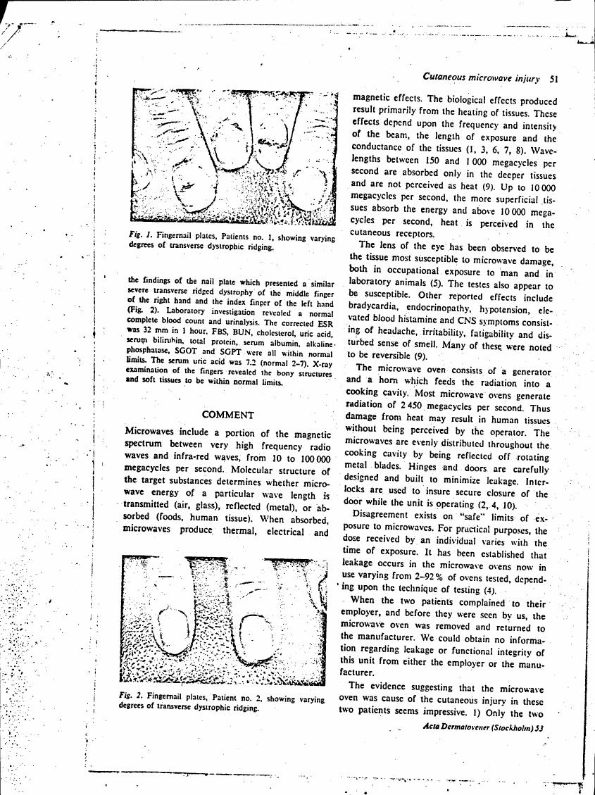 Fingernail plates from Patients no. 1 and 2 showing varying degrees of transverse dystrophic ridging.