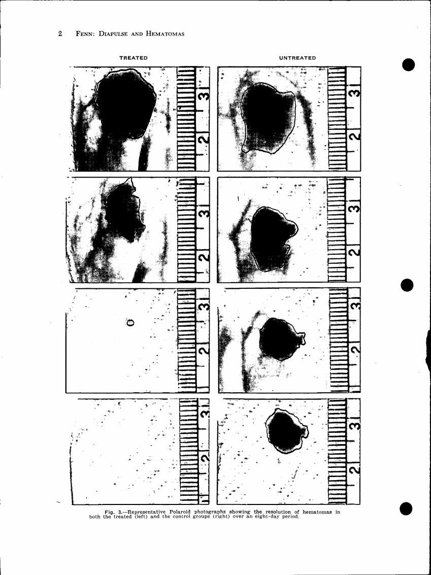Fig. 3 - Representative Polaroid photographs showing the resolution of hematomas in both treated (left) and untreated groups (right) over an eight-day period.
