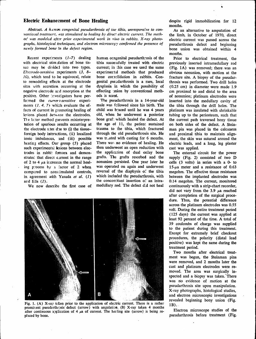 AI-described figure: X-ray images showing a pseudarthrosis defect before and after electrical treatment.
