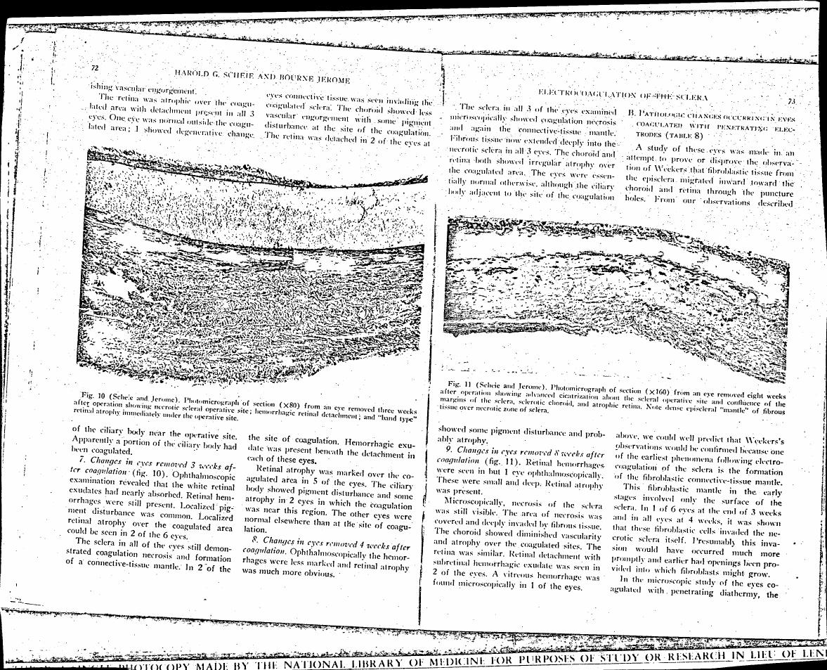 Photomicrograph of section (×80) from an eye removed three weeks after operation showing necrotic scleral operative site; hemorrhagic retinal detachment; and 'band type' retinal atrophy immediately under the operative site.