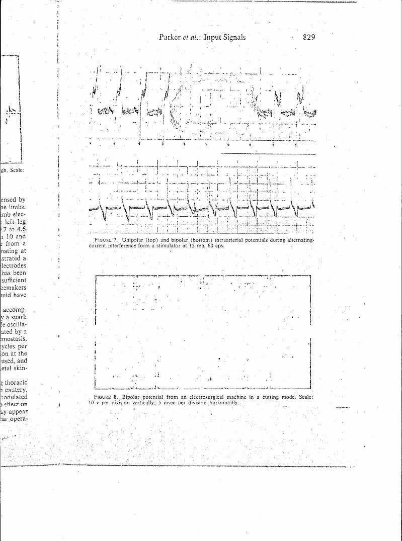 Figure 7 displays unipolar and bipolar intraarterial potentials during alternating current interference from a stimulator at 15 mA, 60 cps.