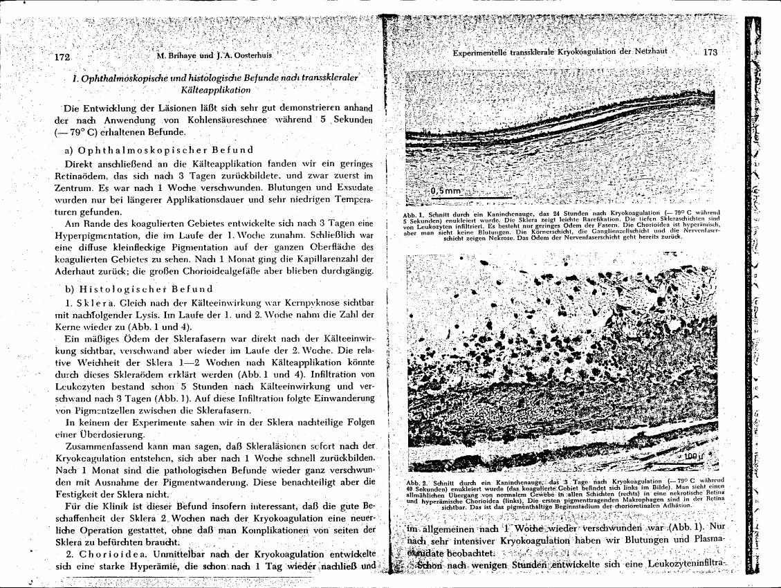 AI-described figure: Histological cross-sections showing changes in sclera and choroid after cryocoagulation