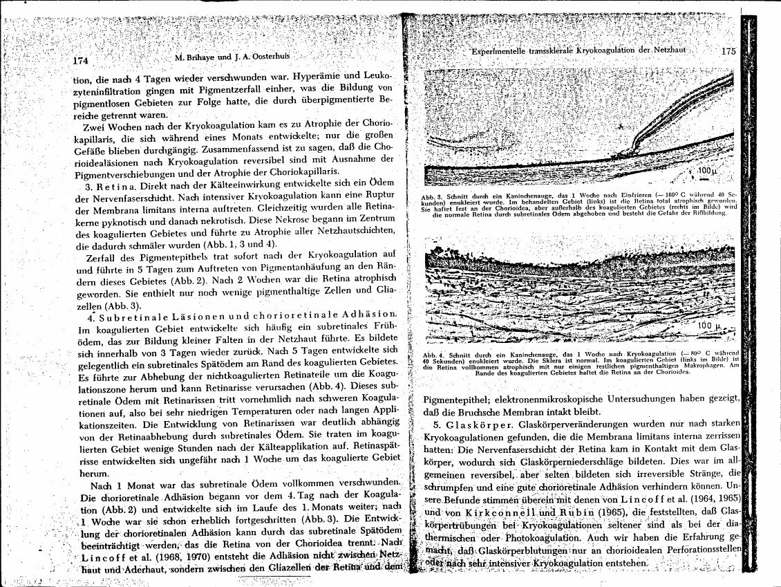 AI-described figure: A diagram showing a cross-section through an animal's eye, illustrating retinal atrophy and choroidal changes after cryocoagulation.