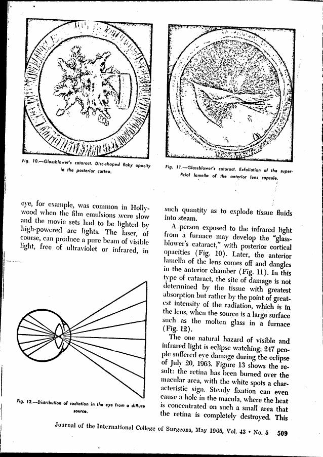 AI-described figure: Figures 10 and 11 depict illustrations of glassblower's cataract, showing disc-shaped flaky opacity in the posterior cortex and exfoliation of the superficial lamella of the anterior lens capsule.