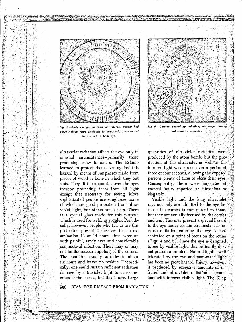 AI-described figure: Figures showing early and late stages of radiation cataract in eyes.