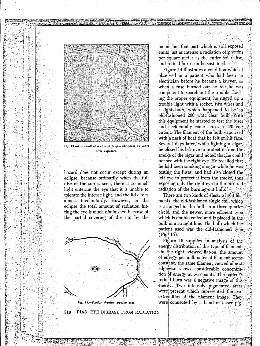 AI-described figure: Figure 14 illustrates a condition observed in an electrician who accidentally exposed his right eye to infrared radiation from a vaporized light bulb filament.