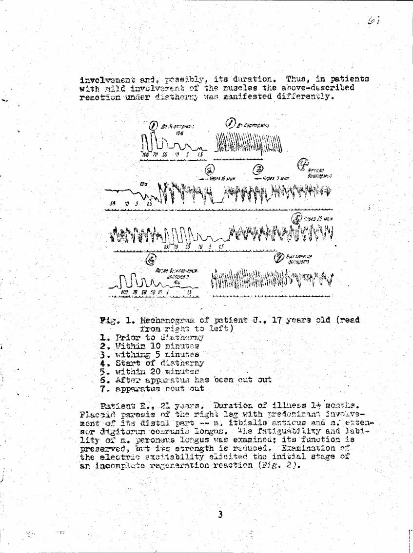 Fig. 1: Mechanogram of patient J., 17 years old (read from right to left)