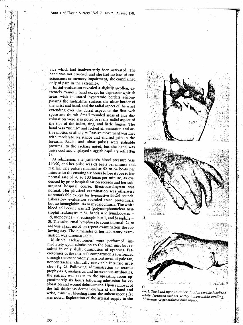 The hand upon initial evaluation reveals localized white depressed eschars without appreciable swelling, blistering, or generalized burn injury.