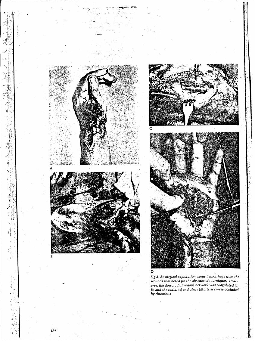 AI-described figure: Fig. 3: Surgical exploration showing hemorrhage from wounds and occlusion of veins and arteries by thrombus.