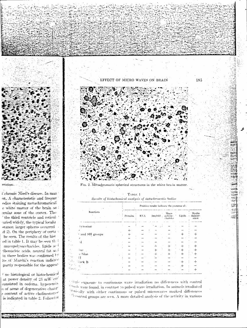 Fig. 2: Metachromatic spherical structures in the white brain matter.