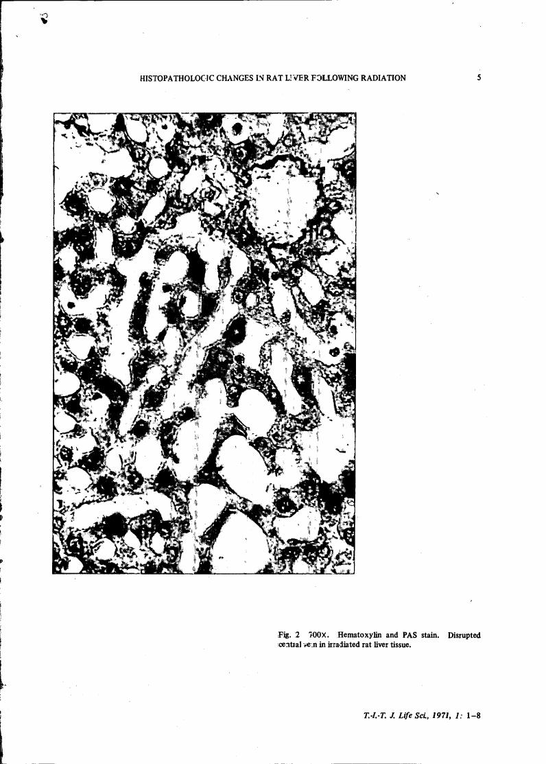 AI-described figure: Fig. 2: A high-magnification (700x) view of hematoxylin and PAS-stained liver tissue showing disrupted central veins in irradiated rat liver.