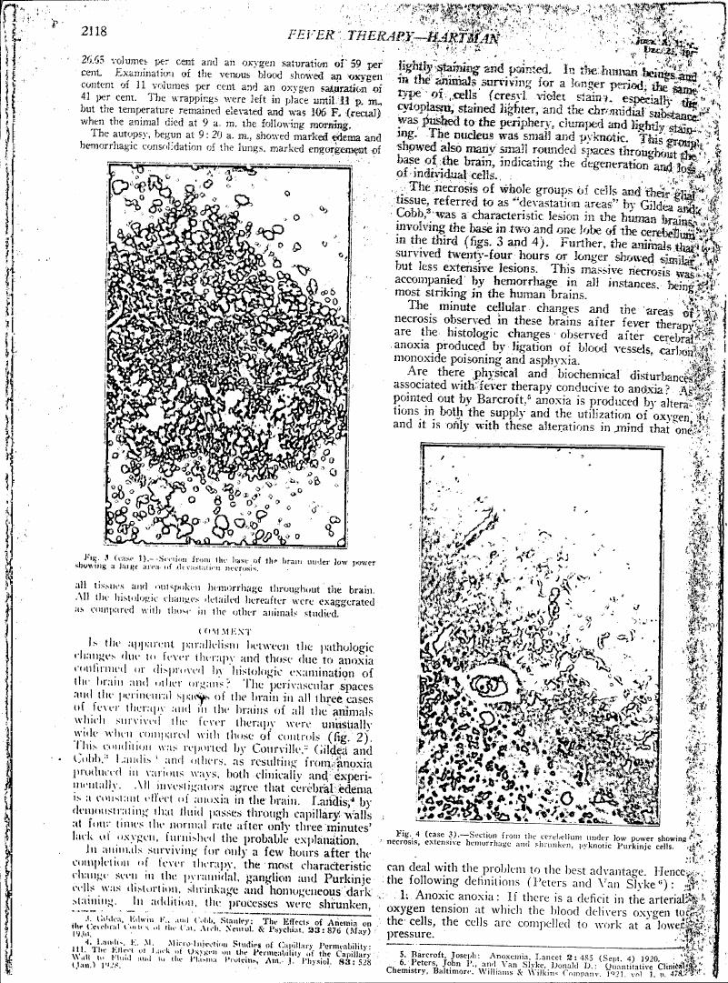 AI-described figure: Histological sections from a brain showing areas of devascularization and necrosis in case 1 (Fig. 3) and cerebellum with extensive hemorrhage, shrinkage, and pyknotic Purkinje cells in case 3 (Fig. 4).
