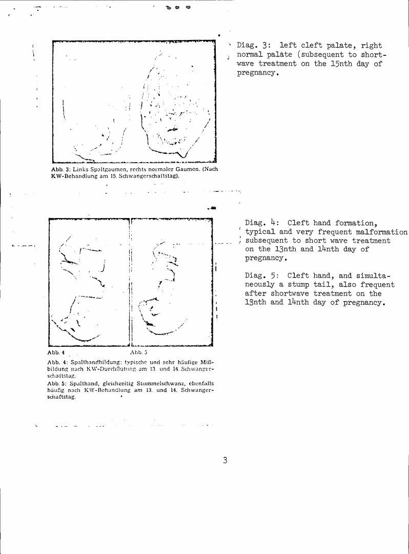 AI-described figure: Diagrams showing cleft palate and hand malformations following shortwave treatment during pregnancy.