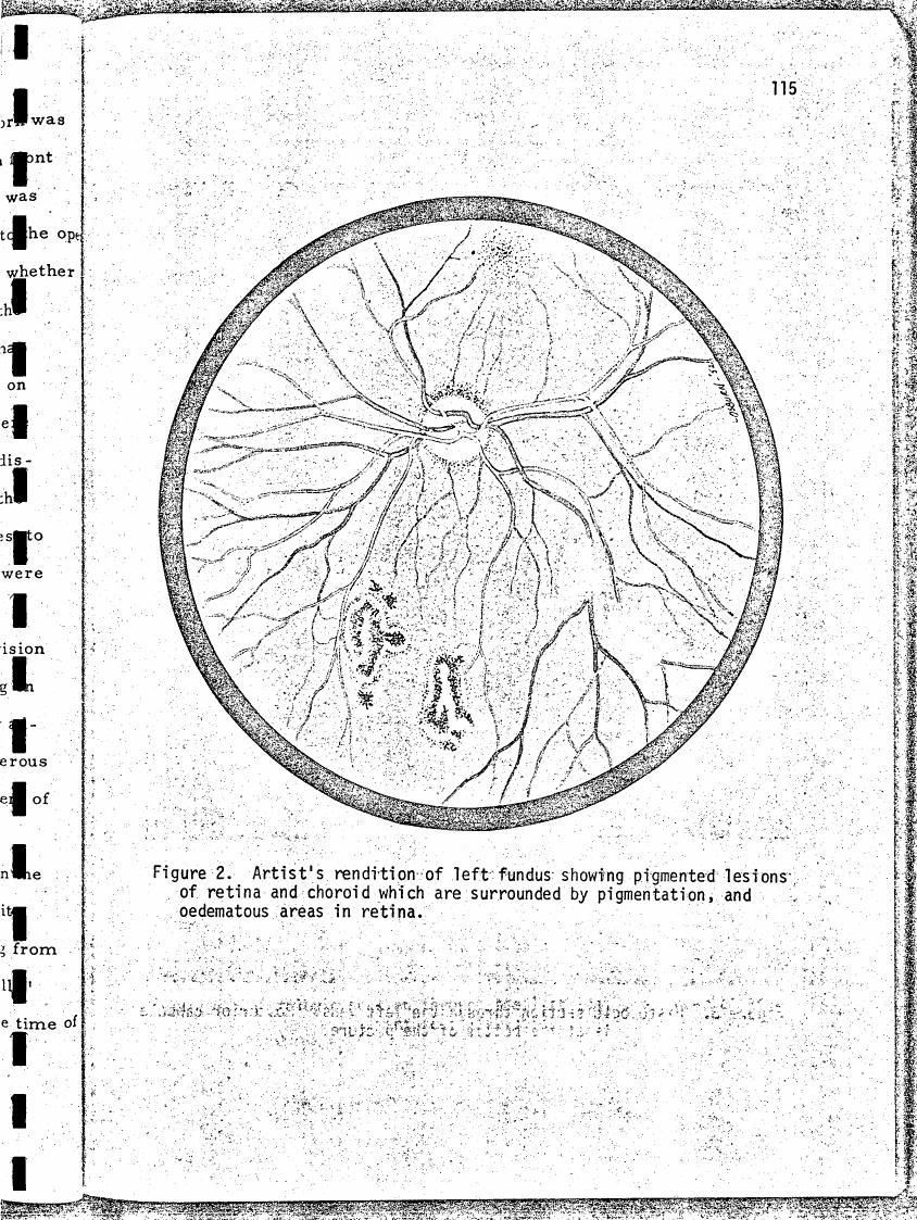 Figure 2. Artist's rendition of left fundus showing pigmented lesions of retina and choroid which are surrounded by pigmentation, and oedematous areas in retina.