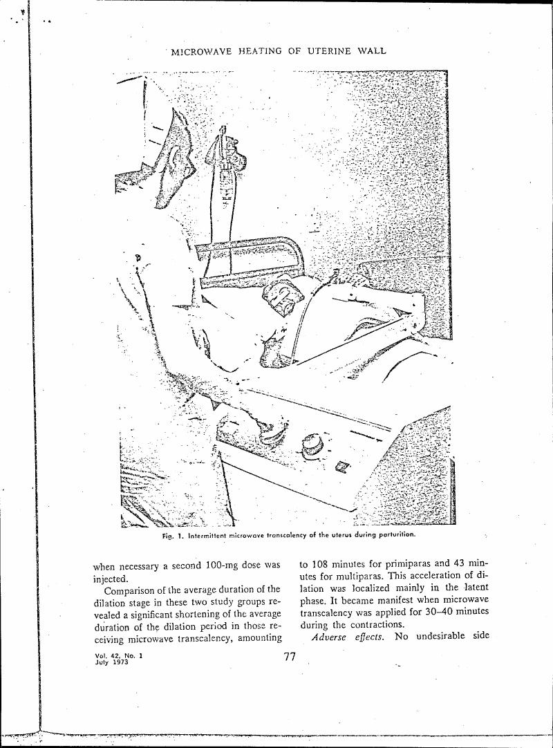 Fig. 1: Intermittent microwave transcolency of the uterus during parturition.