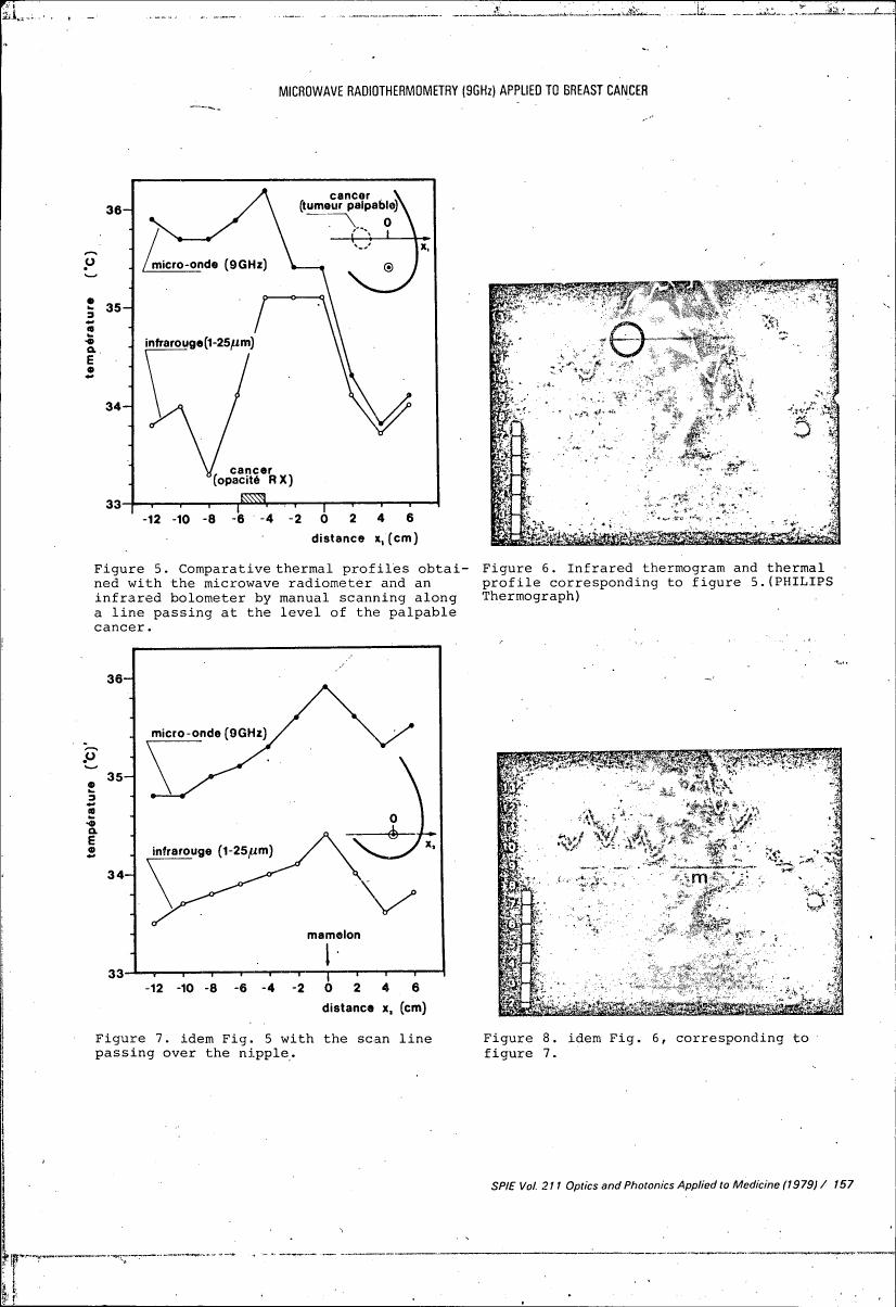 Figure 5. Comparative thermal profiles obtained with the microwave radiometer and an infrared bolometer by manual scanning along a line passing at the level of the palpable cancer.