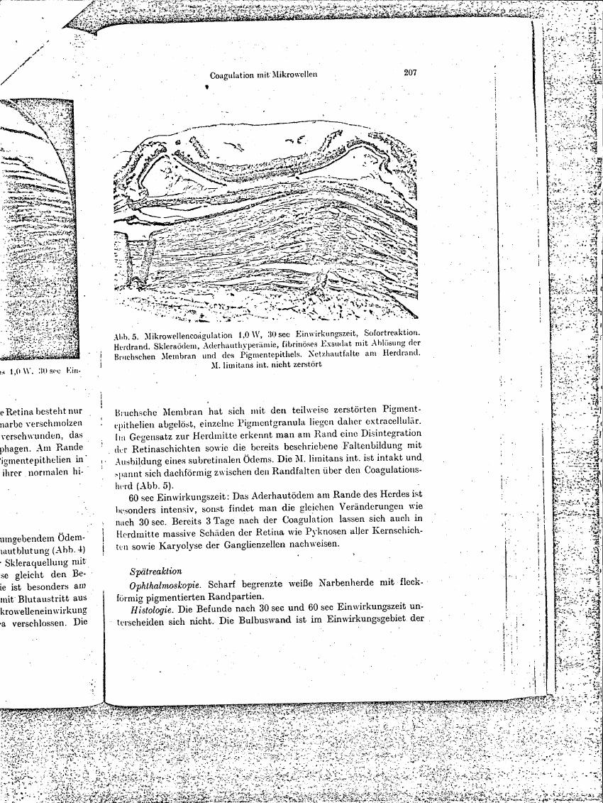 AI-described figure: Figure 5 illustrates a histological section showing the effects of microwave coagulation on retinal tissue, including changes in the Bruch's membrane and pigment epithelium.