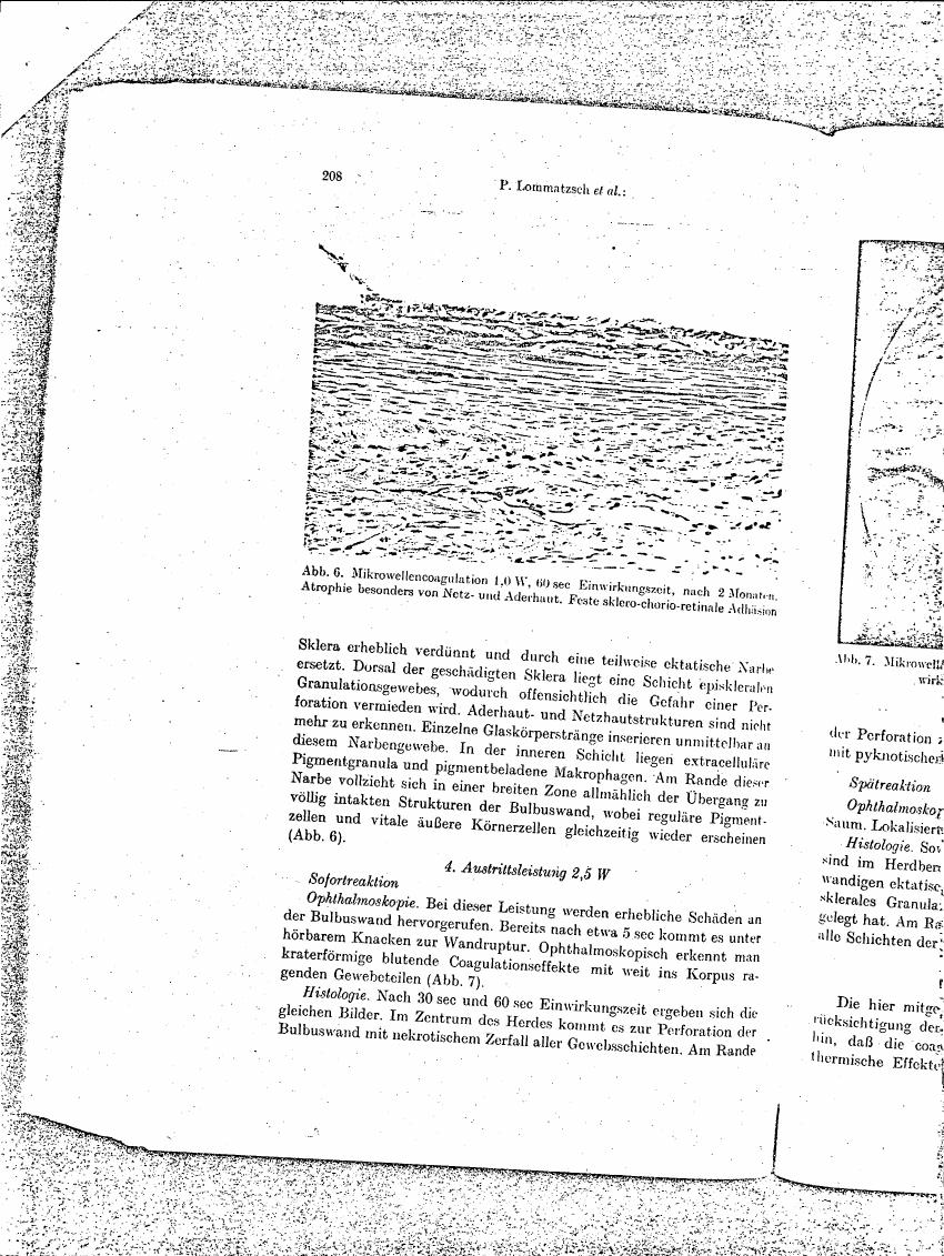 AI-described figure: Figure 6 illustrates a histological section showing the effects of microwave coagulation on scleral tissue after two months.