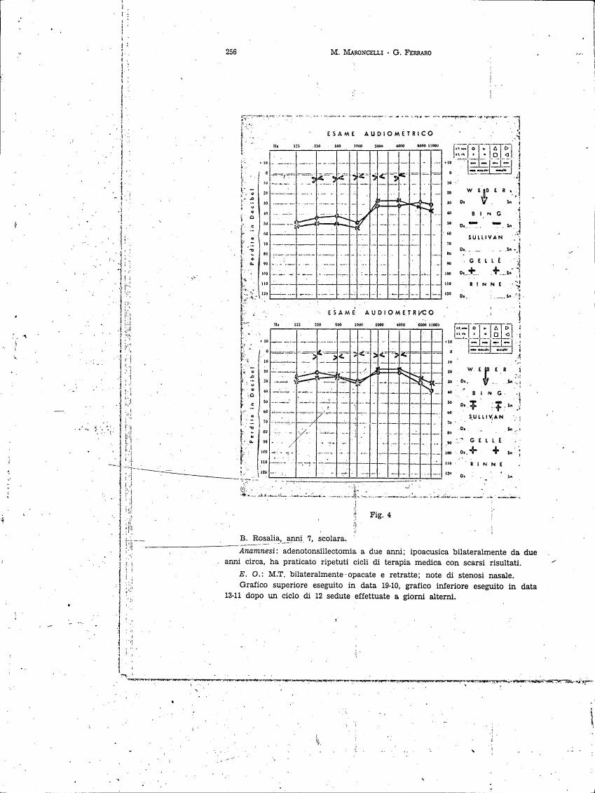 AI-described figure: Figure 4: Audiometric examination results for B. Rosalia, a 7-year-old schoolgirl with bilateral adenotonsillectomy and history of recurrent medical therapy.