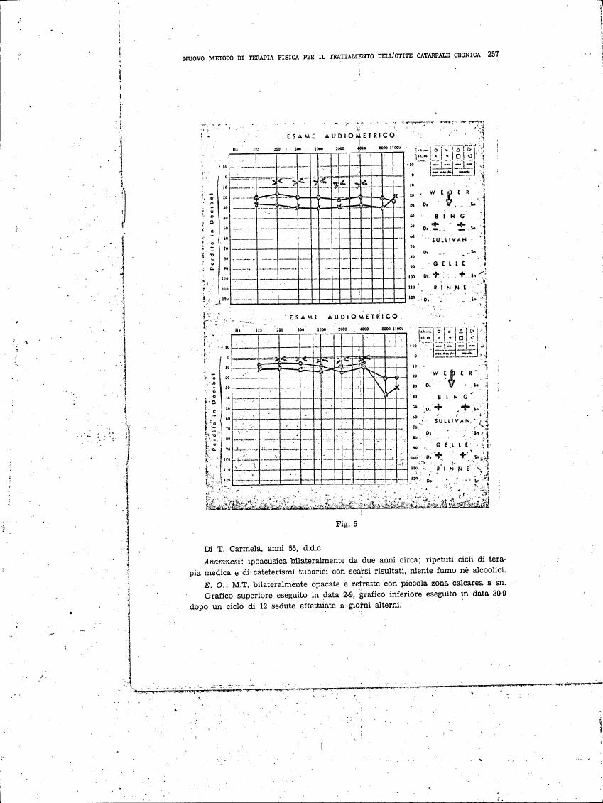 AI-described figure: Figure 5: Audiometric examination results for a patient with chronic otitis media.