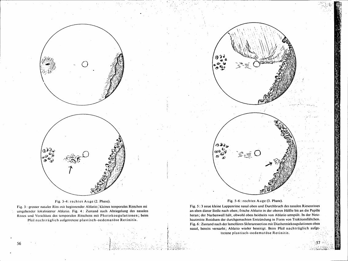 AI-described figure: A series of diagrams illustrating stages in a medical condition affecting the retina and eye, labeled as '2. Phase' and '3. Phase'.