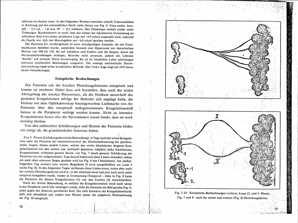 Fig. 7-25: Entoptische Beobachtungen rechtes Auge (2. und 3. Phase). Fig. 7 and 8: nach der ersten und zweiten (Fig. 8) Photokoagulation.