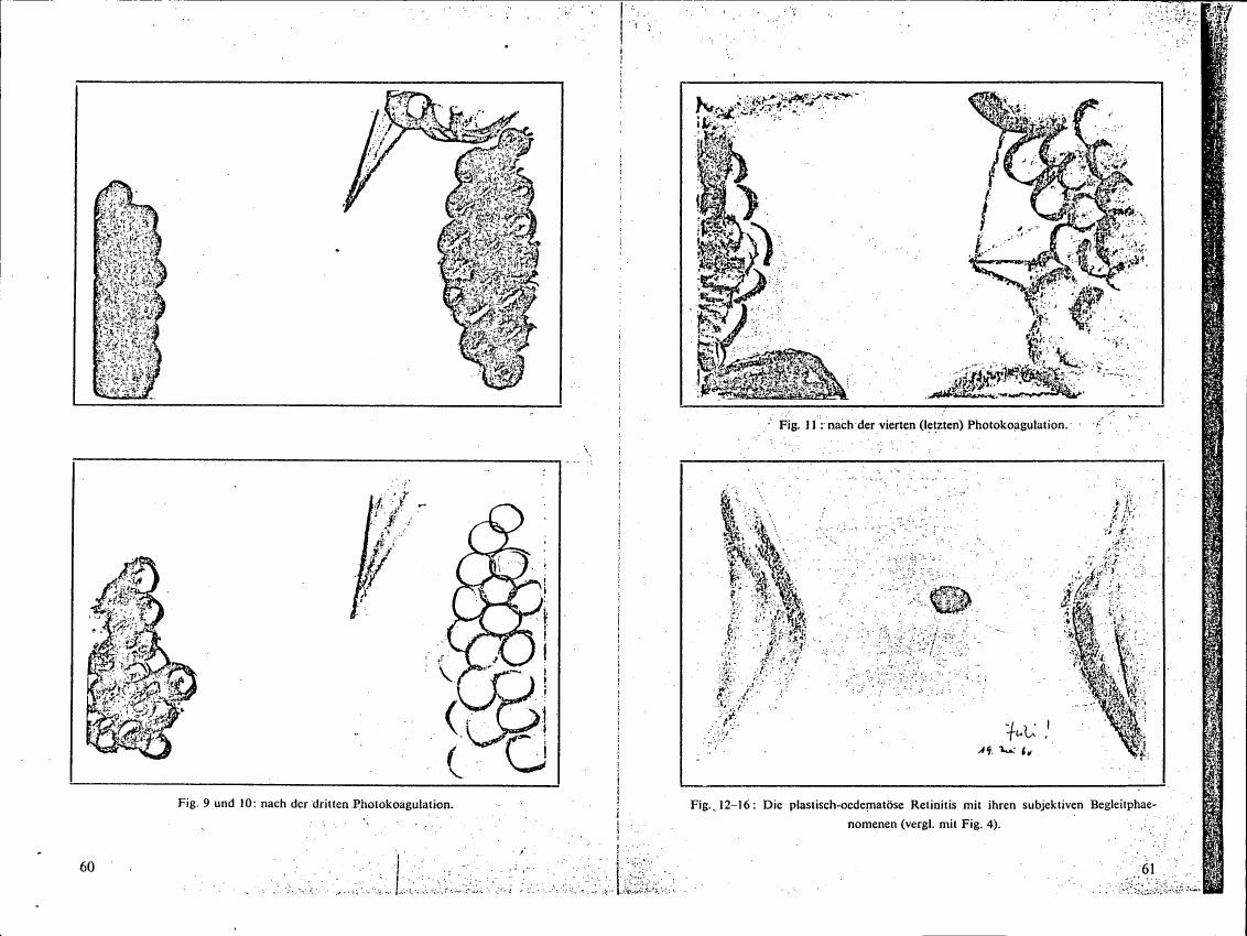 AI-described figure: Illustrations showing stages of a medical procedure labeled as 'Photokoagulation' and related retinal conditions.