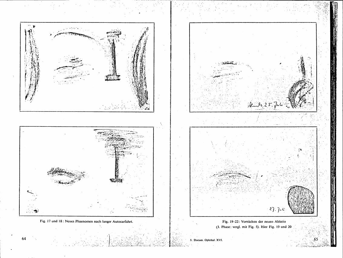 AI-described figure: Figures 17-22 depict a sequence showing new phenomena after long car rides and progression of an eye condition.