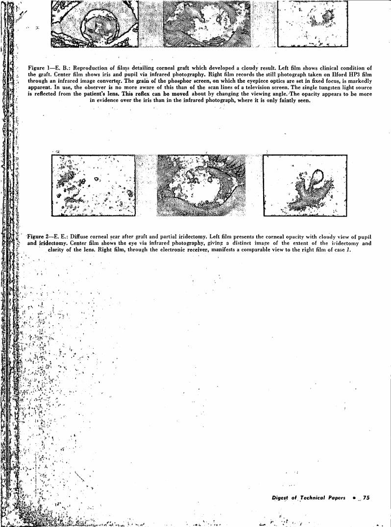 Figure 1-E. B.: Reproduction of films detailing corneal graft which developed a cloudy result.