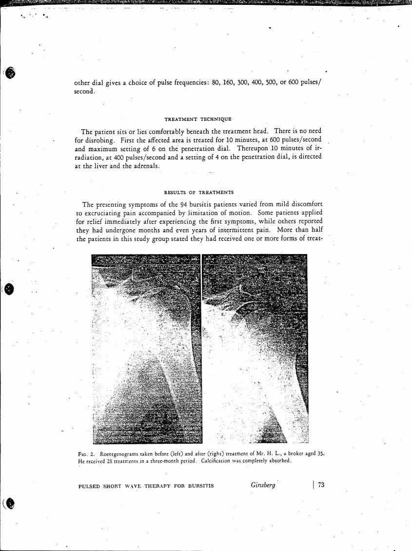 AI-described figure: Roentgenograms taken before (left) and after (right) treatment of Mr. H. L., a broker aged 35, showing complete absorption of calcification.