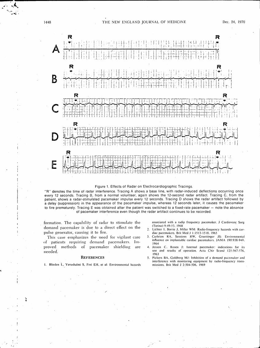 Figure 1. Effects of Radar on Electrocardiographic Tracings.