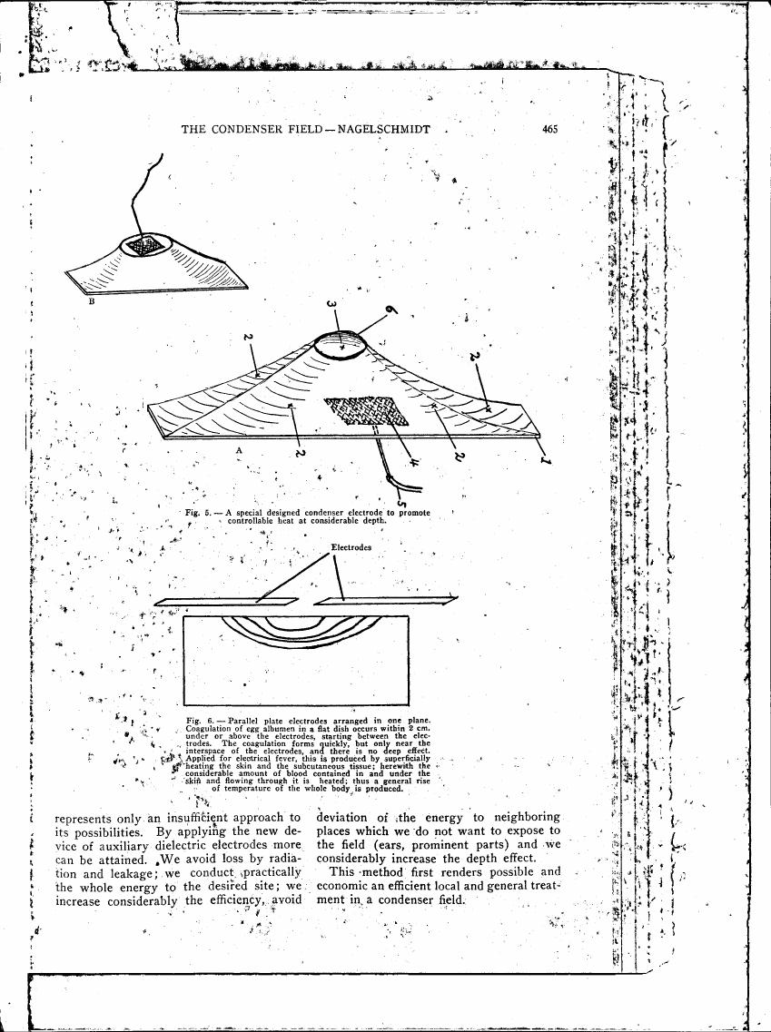 AI-described figure: Fig. 5 - A special designed condenser electrode to promote controllable heat at considerable depth.