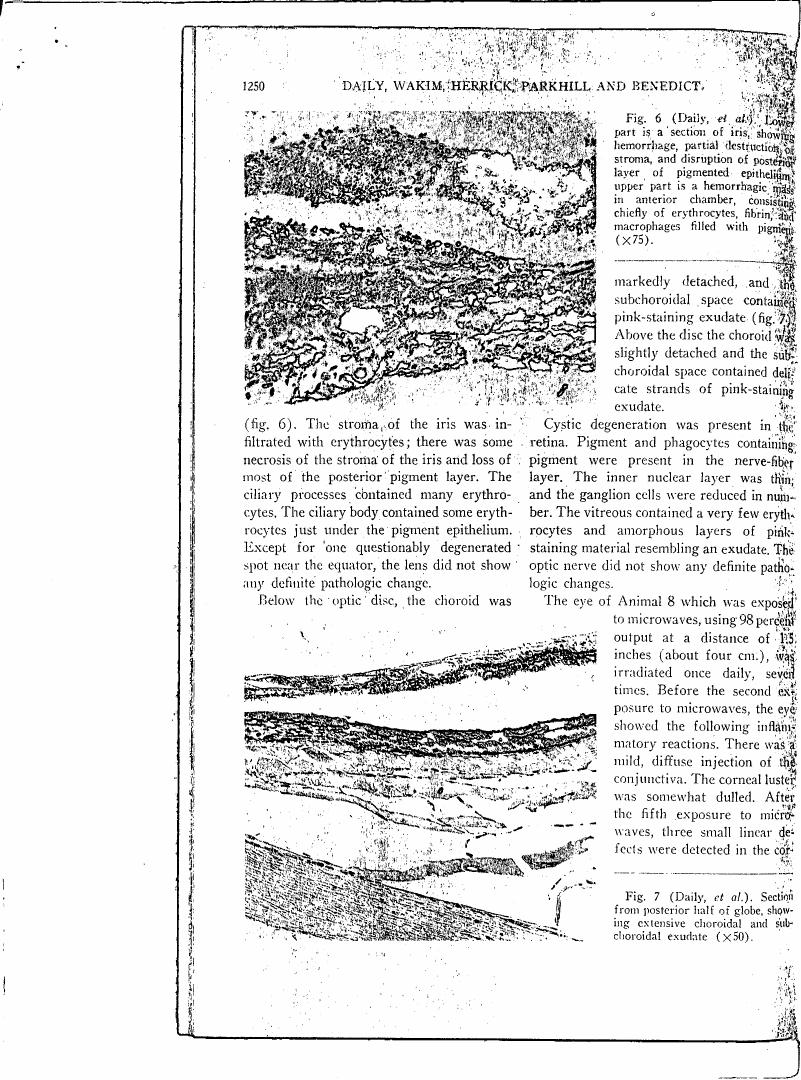 Fig. 6 (Daily et al.) depicts a section of iris showing hemorrhage and disruption of posterior pigment epithelium.