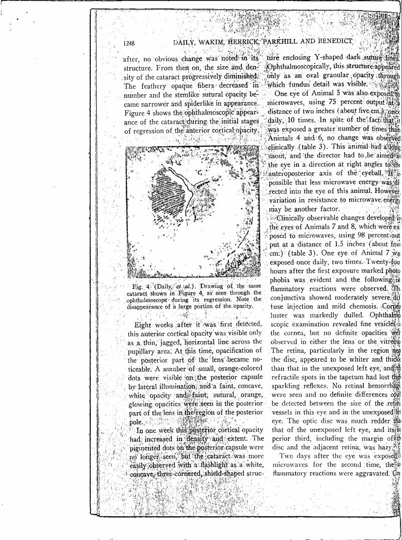 Figure 4 depicts a drawing showing the regression of an ophthalmoscopic cataract during its initial stages.
