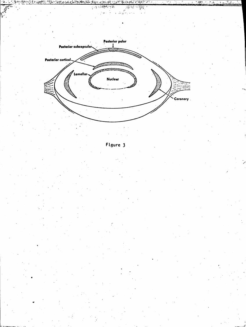 AI-described figure: Figure 3 illustrates a cross-sectional diagram of an eye structure with labeled parts such as posterior subcapsular, posterior cortical, lamellar, nuclear, and coronary.