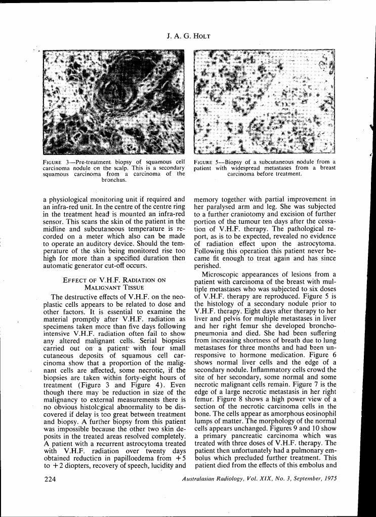 Figure 3 depicts a pre-treatment biopsy of a squamous cell carcinoma nodule on the scalp.