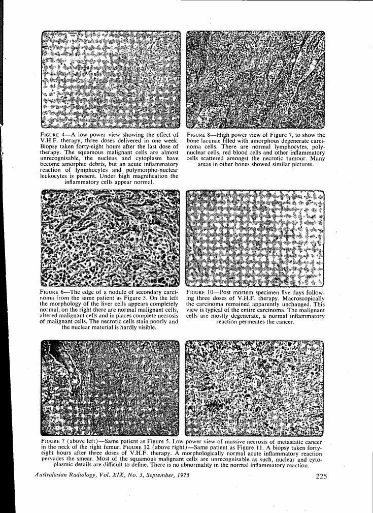 AI-described figure: Microscopic views showing the effects of V.H.F. therapy on cancer cells and surrounding tissue in a patient with secondary carcinoma.