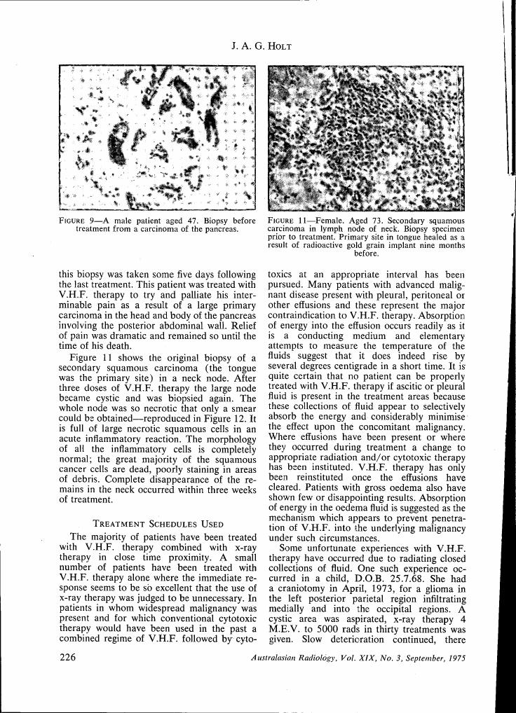 AI-described figure: Microscopic images showing biopsies from patients with squamous carcinoma. Figure 9 depicts a male patient aged 47 before treatment for pancreatic cancer, while Figure 11 shows a female patient aged 73 with secondary squamous carcinoma in the lymph node of the neck.