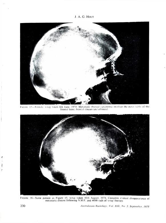 AI-described figure: Figure 15 and Figure 16 show X-rays taken on different dates in 1974 of a female patient with metastatic thyroid carcinoma, highlighting the progression and response to treatment.