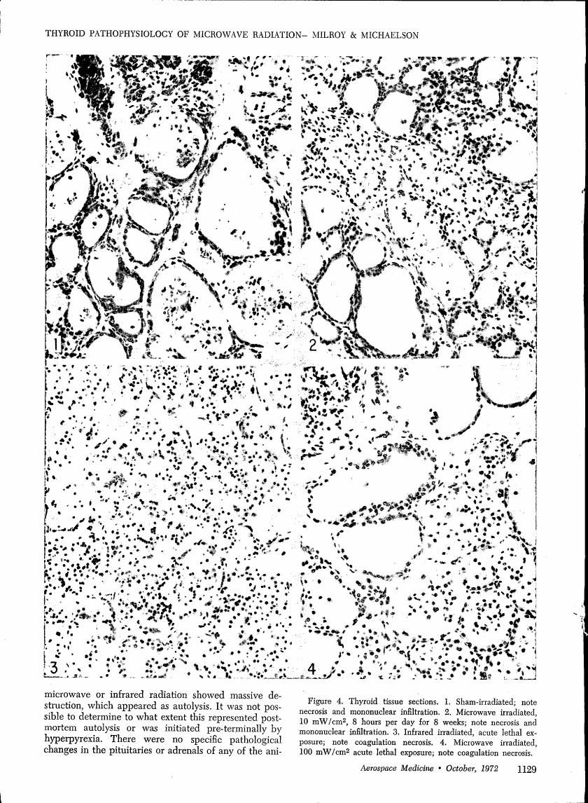 AI-described figure: Figure 4. Thyroid tissue sections showing various types of irradiation effects on thyroid cells.