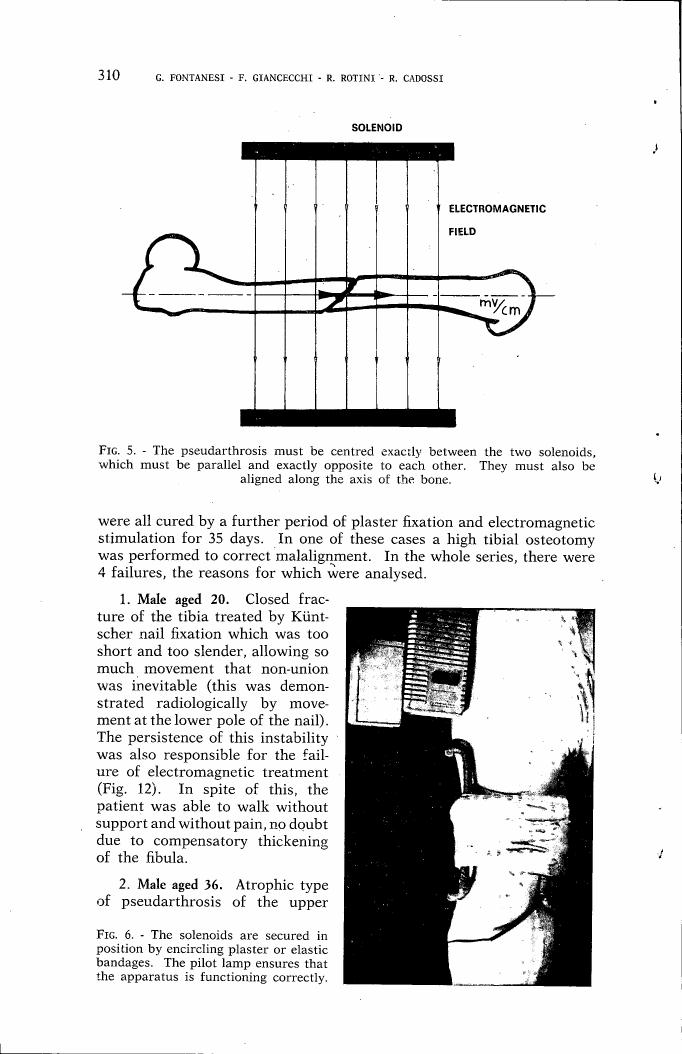 AI-described figure: Figure 5 illustrates the alignment and positioning requirements for a pseudarthrosis treatment using solenoids to create an electromagnetic field.